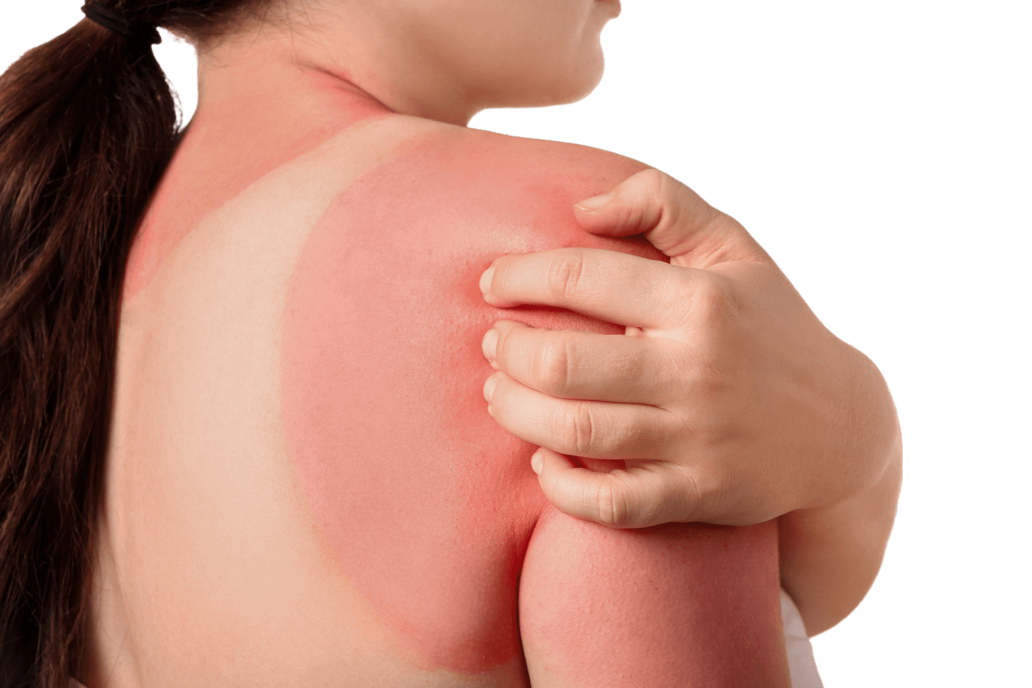 The Impact of the Sun on Psoriasis: An Overview - NanoCupper USA