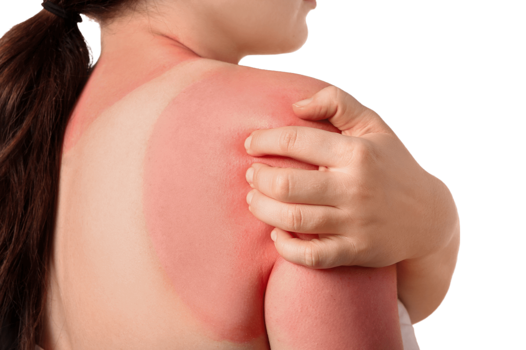 The Impact of the Sun on Psoriasis: An Overview - NanoCupper USA